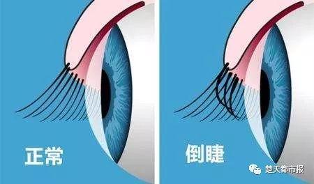 宝宝育儿小常识眼睛（2岁大眼萌娃差点瞎了）(5)