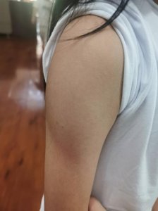 ​打什么疫苗胳膊上有疤（打什么疫苗胳膊上会留疤）