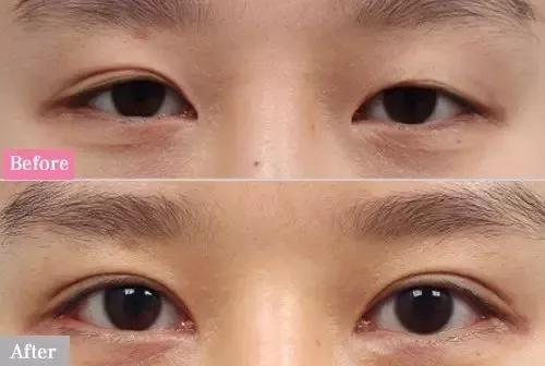 秦海璐割双眼皮前后对比照（秦海璐美出新高度的双眼皮是割的）(4)