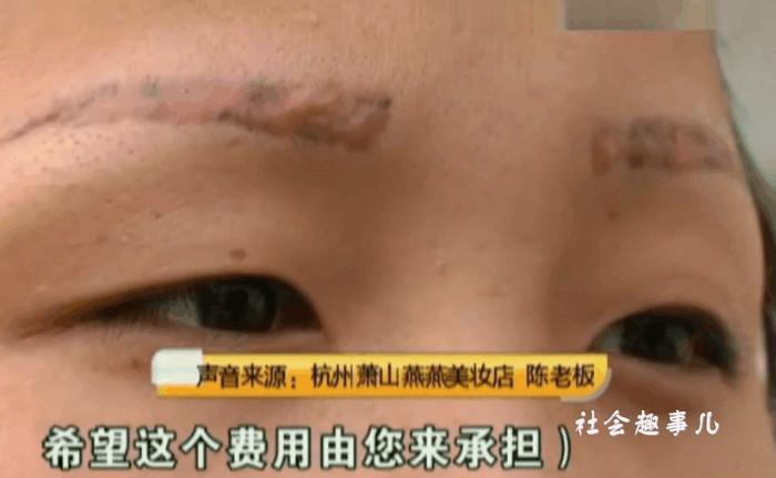 女子本来是激光洗眉 可如今纹眉不仅没洗掉还差点毁容