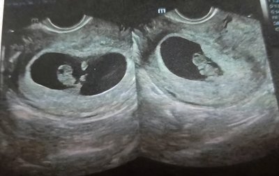 ​已生男孩孕囊图片分享：根据数据和形状看男女真的很准