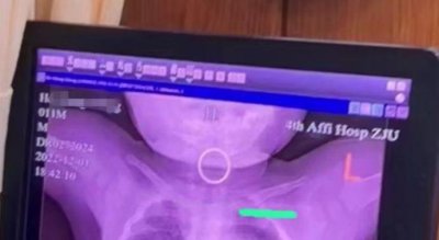 ​幼童误吞戒指卡喉，医生一招取出！