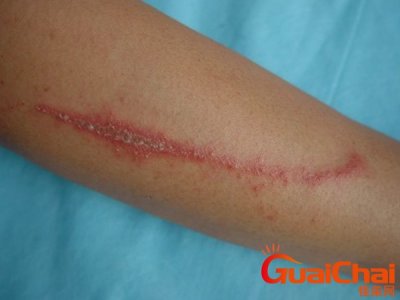 ​隐翅虫咬人后图片症状 隐翅虫咬人后图片伤口